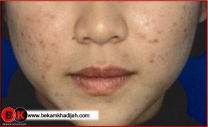Read more about the article BEKAM UNTUK MASALAH RESDUNG DAN JERAWAT